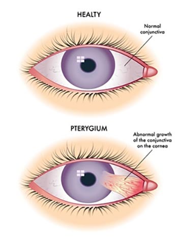 Pterygium Surgery