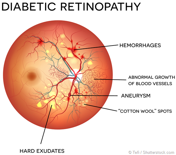 Diabetic Retinopathy